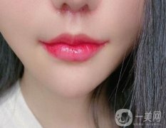 怎么做微笑唇整形手術(shù)？有什么風(fēng)險？