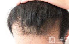 前額毛發(fā)種植多少錢?能持續(xù)多久?