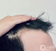 現(xiàn)在植發(fā)一般要多少錢？植發(fā)后有哪些注意事項？