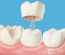 牙齒美容冠能管多久？美容冠矯正牙齒的建議？