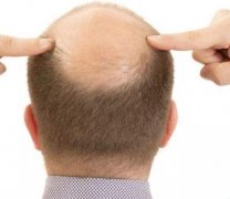 脫發(fā)為什么越來越年輕化？看上海植發(fā)價(jià)格2022版！