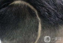 疤痕植發(fā)的一般價(jià)格是多少？疤痕植發(fā)*嗎？