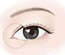 什么樣的眼睛需要開眼角？