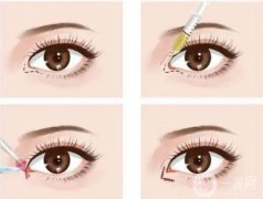 開眼角如何預(yù)防增生？禁忌人群是哪些？