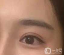 如何讓雙眼皮消腫更快？肉條多久會(huì)消失？