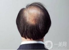 緩解脫發(fā)的幾個(gè)要點(diǎn)，從自身做起!