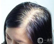 脫發(fā)嚴重怎么辦?如何預(yù)防脫發(fā)?