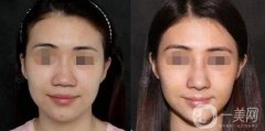 蒜頭鼻整形怎么做?怎么讓蒜頭鼻好看?