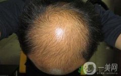 嚴重脫發(fā)的原因是什么?慢性脂溢性脫發(fā)怎么辦?