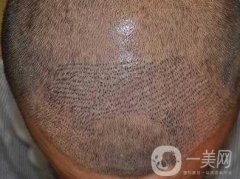 男性脫發(fā)怎么辦?哪些方面會影響植發(fā)的果?