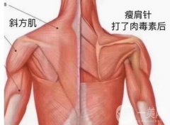 注射瘦肩會影響肩部動作嗎?如何注射注射瘦肩【步驟解析】