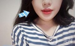 頰脂墊和面部吸脂信息介紹?去除頰脂墊后多久才能看到果?