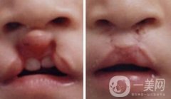 唇腭裂手術(shù)后可以做整容嗎?唇腭裂可以一次修復(fù)嗎?