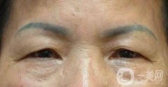 眼皮為什么會(huì)下垂?原因大合集及恢復(fù)辦法