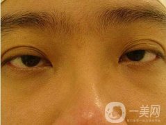 上瞼下垂的分類及矯正辦法介紹