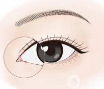 開眼角和眼瞼下至有什么區(qū)別?