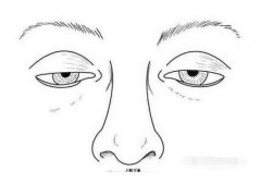 先天性上瞼下垂和后天上瞼下垂的區(qū)別是什么?