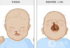 唇腭裂的病因可能是什么?唇腭裂修復(fù)方法有哪些?