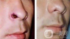 鼻子缺損修復(fù)前需要做哪些準(zhǔn)備?