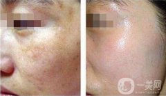 激光祛斑有哪些危害和果?