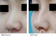 矯正短鼻子需要多少錢?矯正方法是怎樣的?