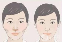 顴骨高是什么樣子的?怎么才能改良?