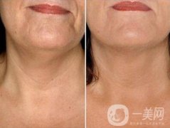 頸部除皺有哪些方法?術(shù)后如何護理?