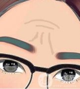 如何消除額頭上的川字紋?