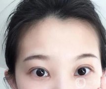 全切雙眼皮肉條和腫脹的區(qū)別是什么？感染的表現(xiàn)是什么？