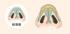 鼻頭縮小手術(shù)有哪些后遺癥?鼻頭縮小的風(fēng)險(xiǎn)大嗎?