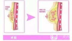 自體脂肪豐胸能維持多久呢?需要多久恢復?