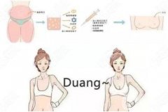 脂肪豐胸能維持幾年呢?需要多少錢?