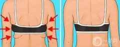 背部抽脂好嗎?會影響身體健康嗎?