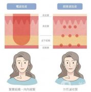 拉皮多少錢?拉皮手術能持續(xù)多久?