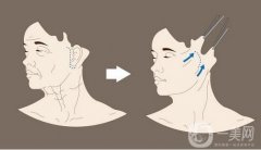 拉皮手術(shù)價格多少錢?影響因素有哪些?