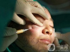 面部吸脂會有后遺癥嗎?面部吸脂會導(dǎo)致面部松弛嗎?