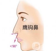 鷹鉤鼻術(shù)后恢復(fù)階段及恢復(fù)提示