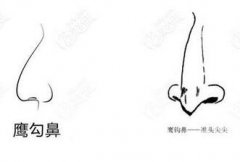 鷹鉤鼻怎么矯正?具體方法是怎樣的?