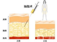 吸脂果怎么樣?抽脂前應(yīng)該知道什么?