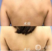 背部吸脂好不好?果怎么樣呢?