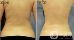 背部抽脂減肥有什么優(yōu)點(diǎn)?背部抽脂有副作用嗎?