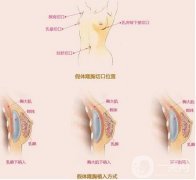 都說假體隆胸排異，這好處你可能還不知道!