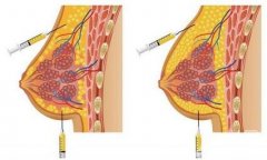 自體脂肪豐胸手術(shù)好嗎?有哪些缺點(diǎn)?