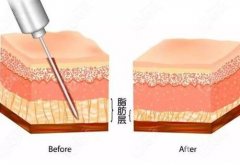 抽脂后皮膚會(huì)松弛嗎?吸脂術(shù)后皮膚松弛的原因是什么?