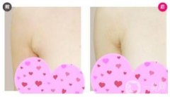 副乳吸脂術(shù)是什么，如何做副乳吸脂術(shù)