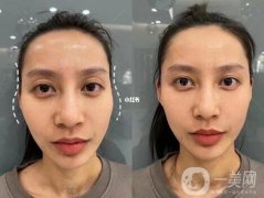 改變太陽穴凹陷有哪些方法?