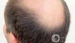 植發(fā)的果能維持多久及植發(fā)后注意事項(xiàng)？