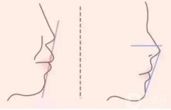 是什么導(dǎo)致嘴唇外翻的呢?