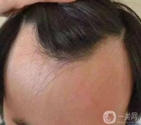 發(fā)際線高怎么辦?做頭發(fā)線移植手術(shù)要多少錢?