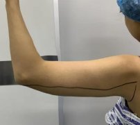 手臂抽脂會(huì)不會(huì)反彈？術(shù)后如何護(hù)理？